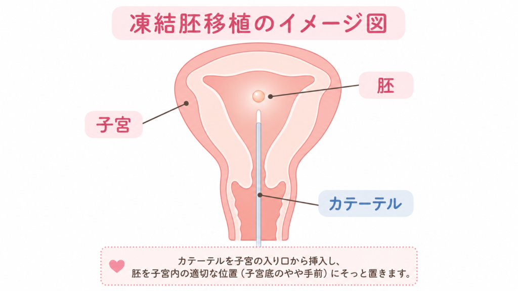 凍結胚移植のイメージ図。カテーテルを子宮に挿入し胚を置く様子